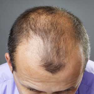 Почему у мужчины выпадают волосы