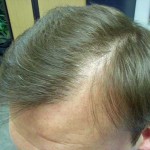 Причины и методы лечения выпадения волос у мужчин