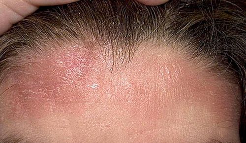 Причины покраснения кожи головы